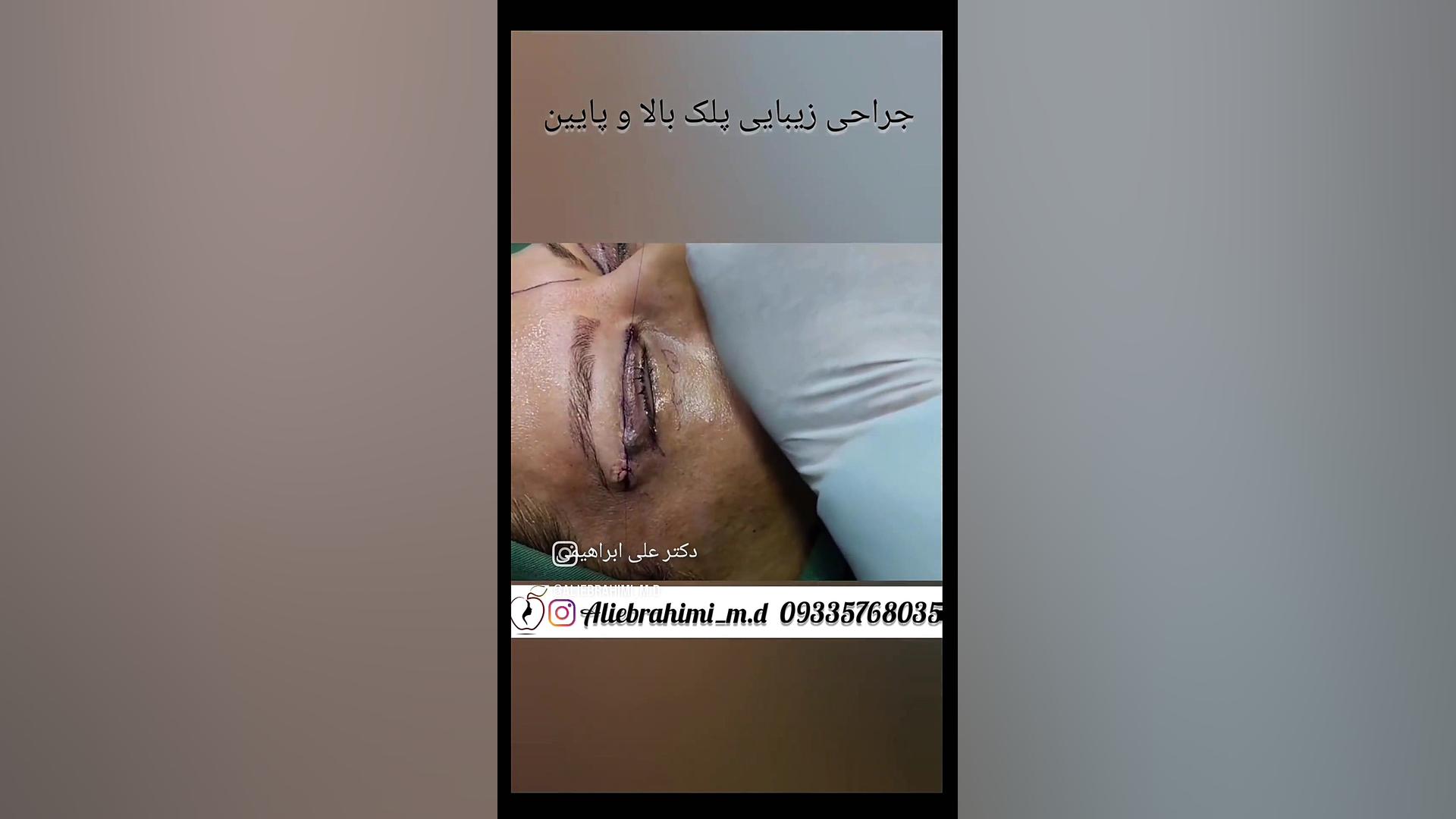 جراحی زیبایی پلک دکتر علی ابراهیمی فوق تخصص جراحی پلاستیک .