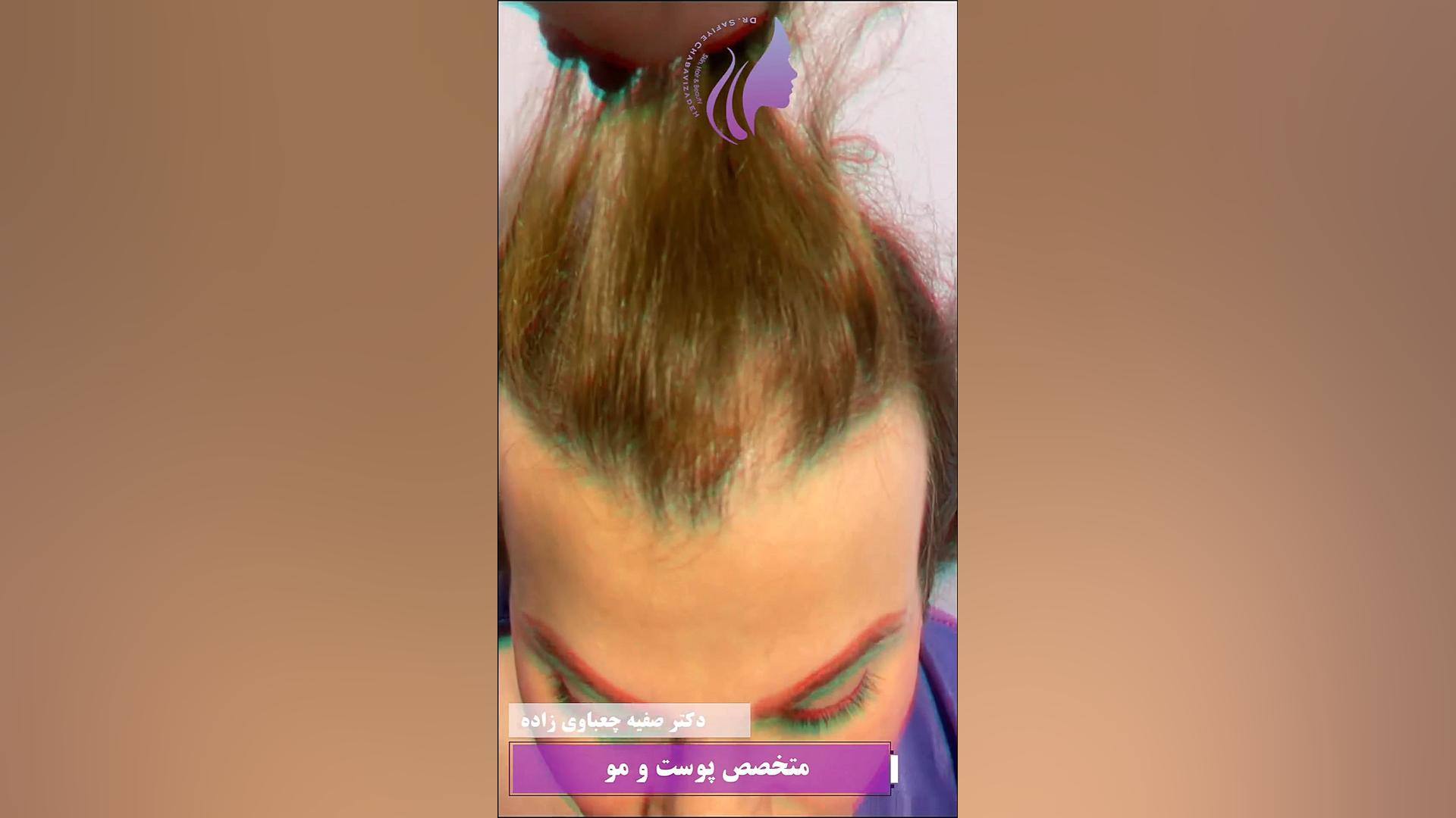 کاشت موی پرتراکم بانوان دکتر صفیه چعباوی زاده