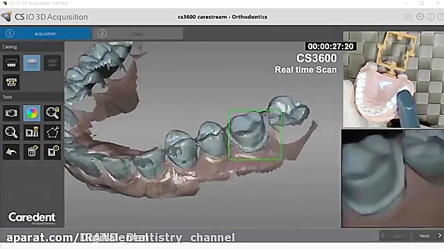 intra oral scanner cs3600 scan procedure آکنه