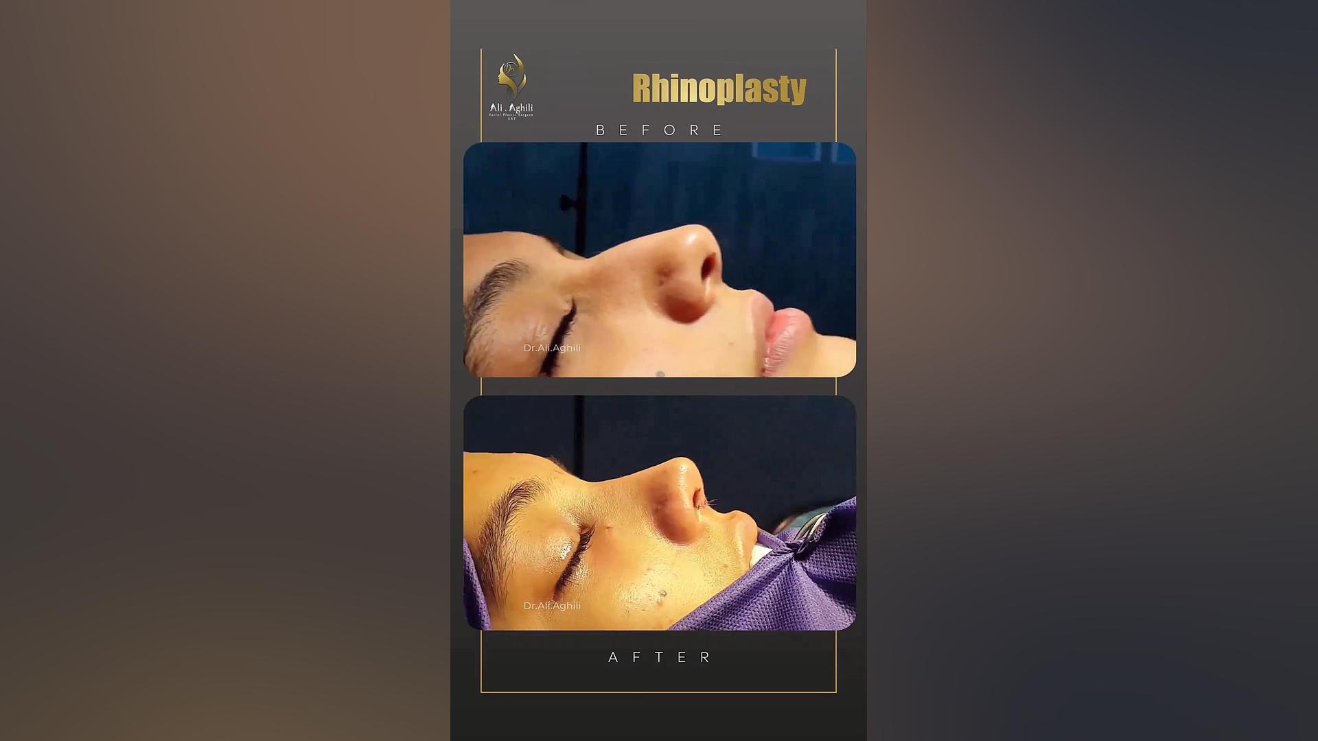 فیلم بلافاصله بعد از جراحی زیبایی بینی در تهران دکتر علی عقیلی - جراح بینی در تهران