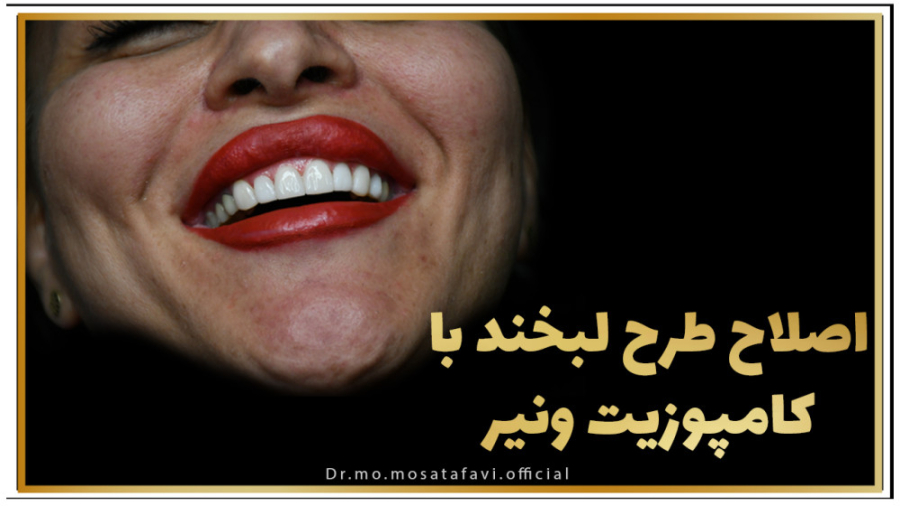 اصلاح طرح لبخند با کامپوزیت ونیر ربات میکرونانو جراحی