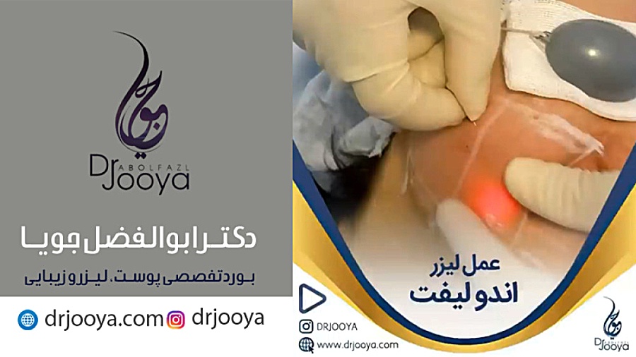 عمل لیزر اندولیفت | بهترین متخصص پوست، مو، لیزر و زیبایی اصفهان دکتر ابوالفضل جویا