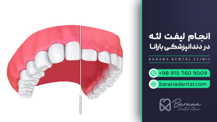 "ترکیب درمان لیفت لثه و بلیچینگ در کلینیک بارانا" میلوشل