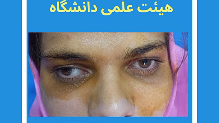 بهترین فوق تخصص استرابیسم دکتر گزین، درمان جراحی انحراف چشم کاندسارتان