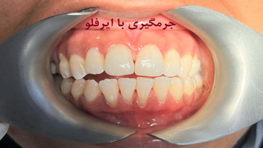 جرمگیری دندان با airflow ترومبوسیتوپنی مقاوم