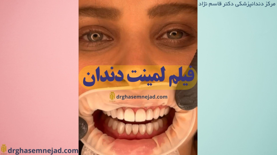 فیلم لمینت دندان دندانپزشکی زیبایی دکتر قاسم نژاد