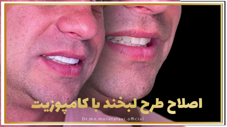 اصلاح طرح لبخند دندان شیری