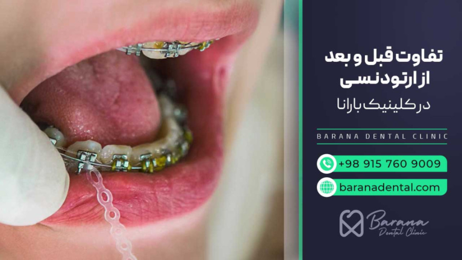 "خدمات ارتودنسی دندان در دندانپزشکی بارانا" لیزر کوانتومی جراحی چشم