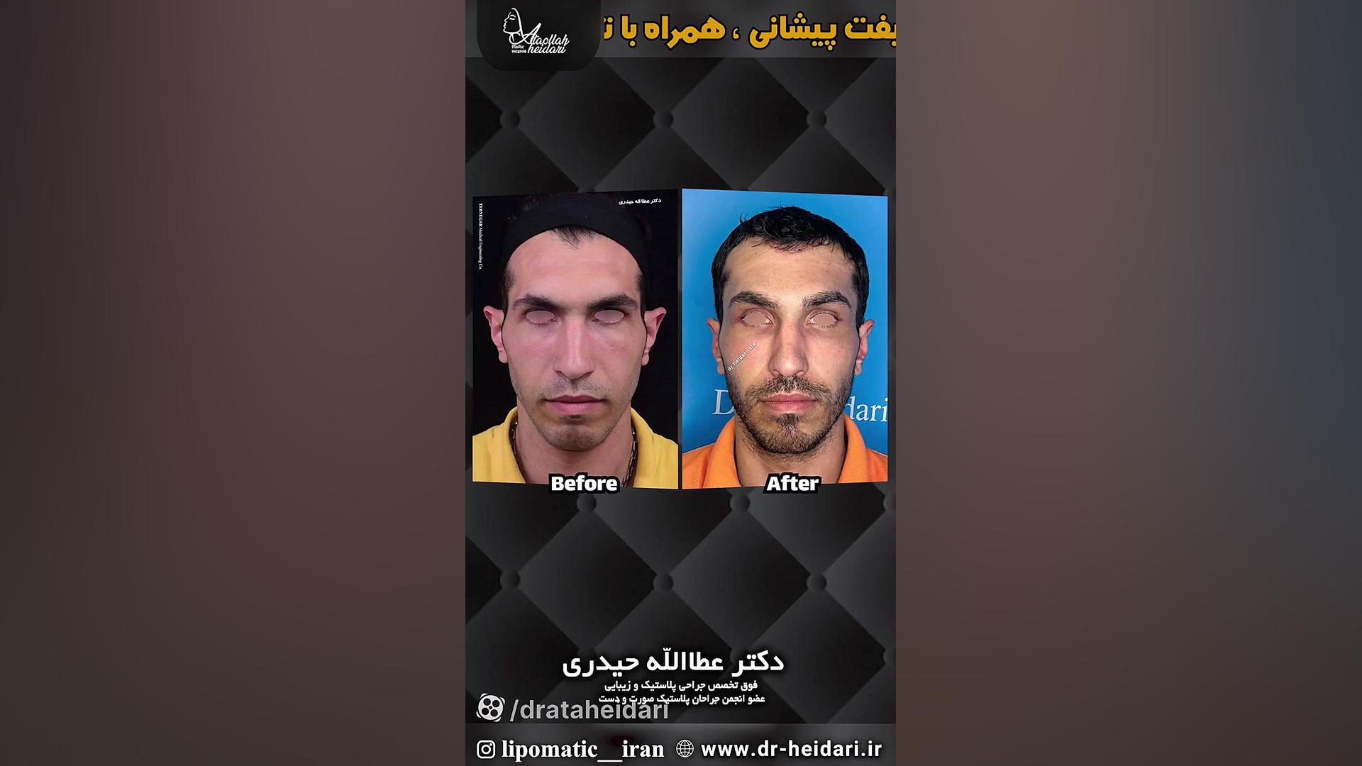 اتوپلاستی و جراحی لیفت پیشانی همراه با تراش وسیع استخوان پیشانی scATAC-Seq