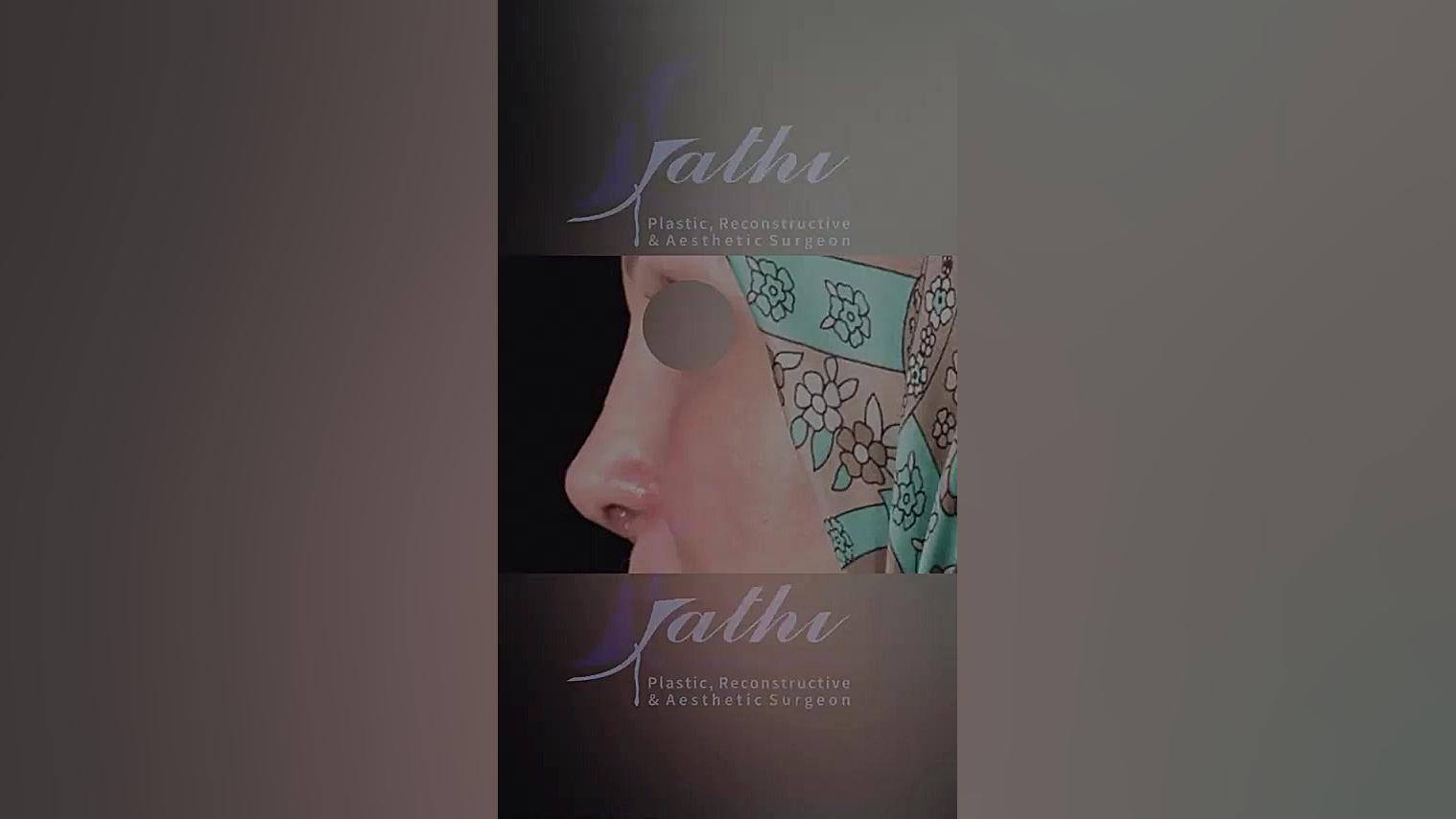 جراحـــی بینــی ثانویه ( ترمیمی ) دکتر حمید رضا فتحی فوق تخصص جراحی پلاستیک