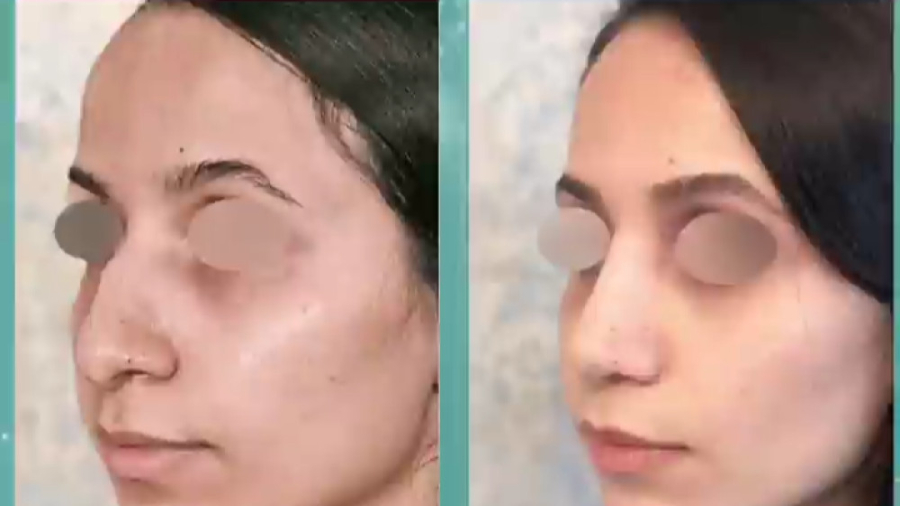 جراحی بینی با انحراف شدید دکتر علی باقری حق
