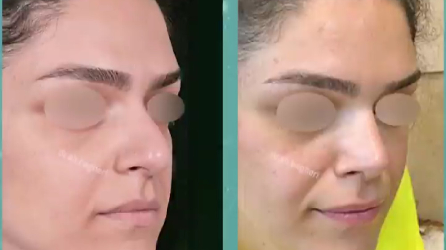 جراحی بینی با پوست حجیم دکتر علی باقری حق
