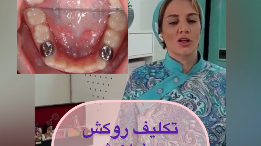 روکش دندان شیری توپوتیکان