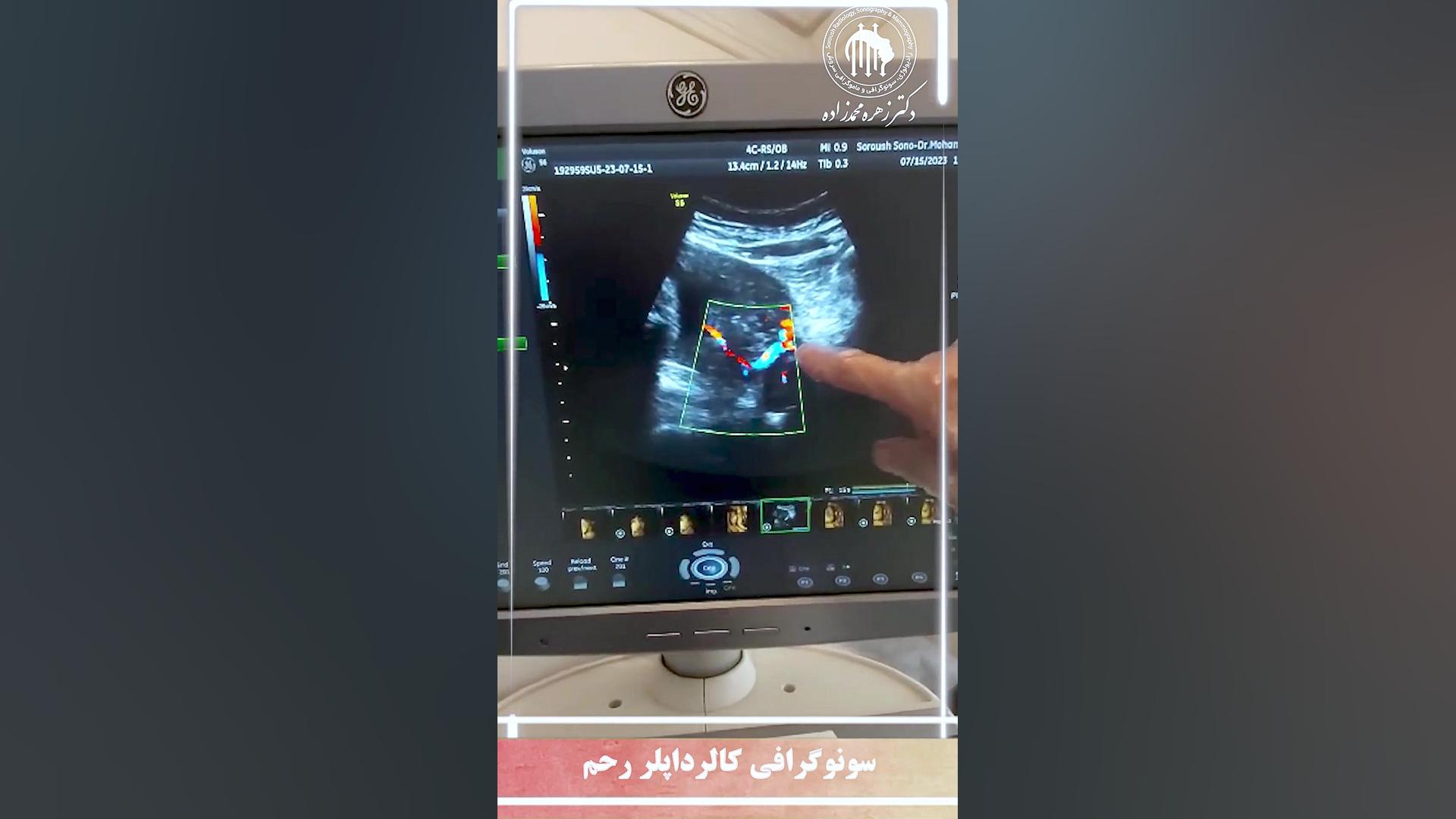 سونوگرافی کالرداپلر رحم لیزر صورت