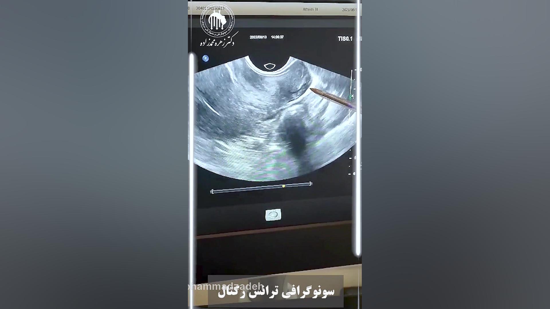 سونوگرافی ترانس رکتال بیماری سندروم آلاژیل
