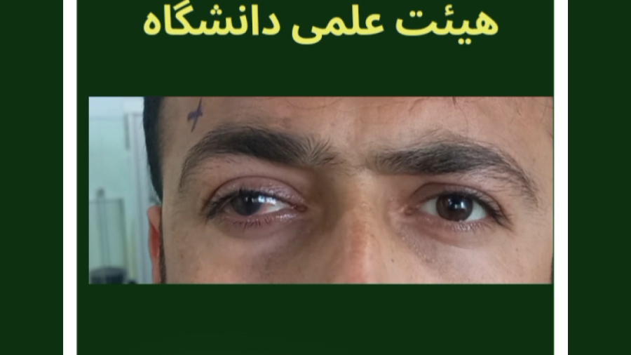 بهترین جراح استرابیسم، دکتر محمد گزین، جراحی انحراف چشم بدون بیهوشی کامل لیفت ابرو
