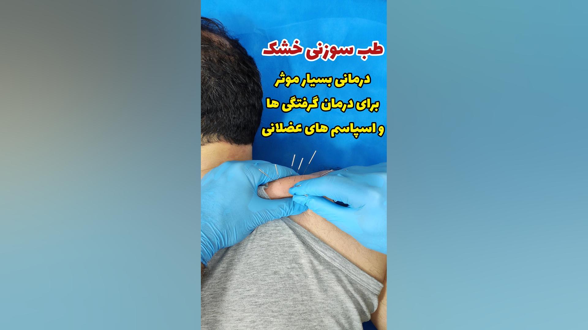 طب سوزنی خشک فیزیوتراپی برای درمان گرفتگی ها و اسپاسم های عضلانی چای خور چای