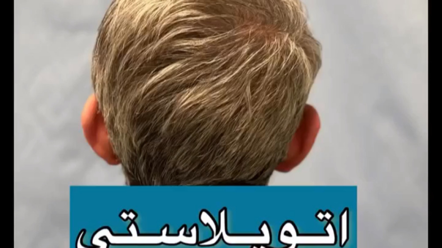 نتیجه بلافاصله پس از جراحی اتوپلاستی | دکتر عبدل زاده پلی‌مایالژیا روماتیکا