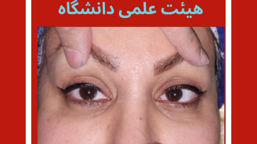 جراحی انحراف چشم بدون بیهوشی کامل، دکتر گزین فوق تخصص استرابیسم ترمیم سوختگی