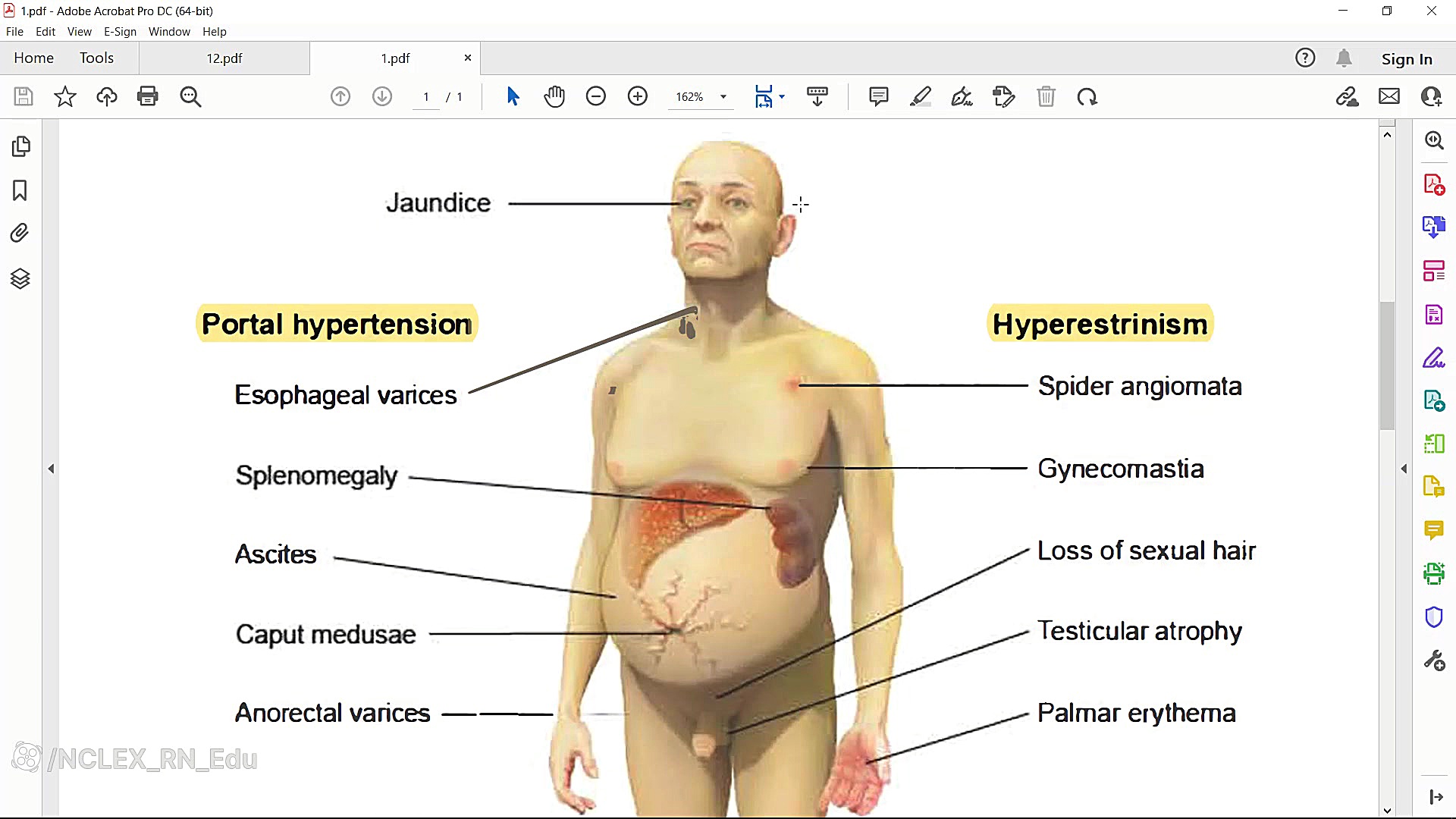 نمونه تست از سوالات نسل جدید یوورلد از مبحث دستگاه گوارش برداشتن خال گوشتی