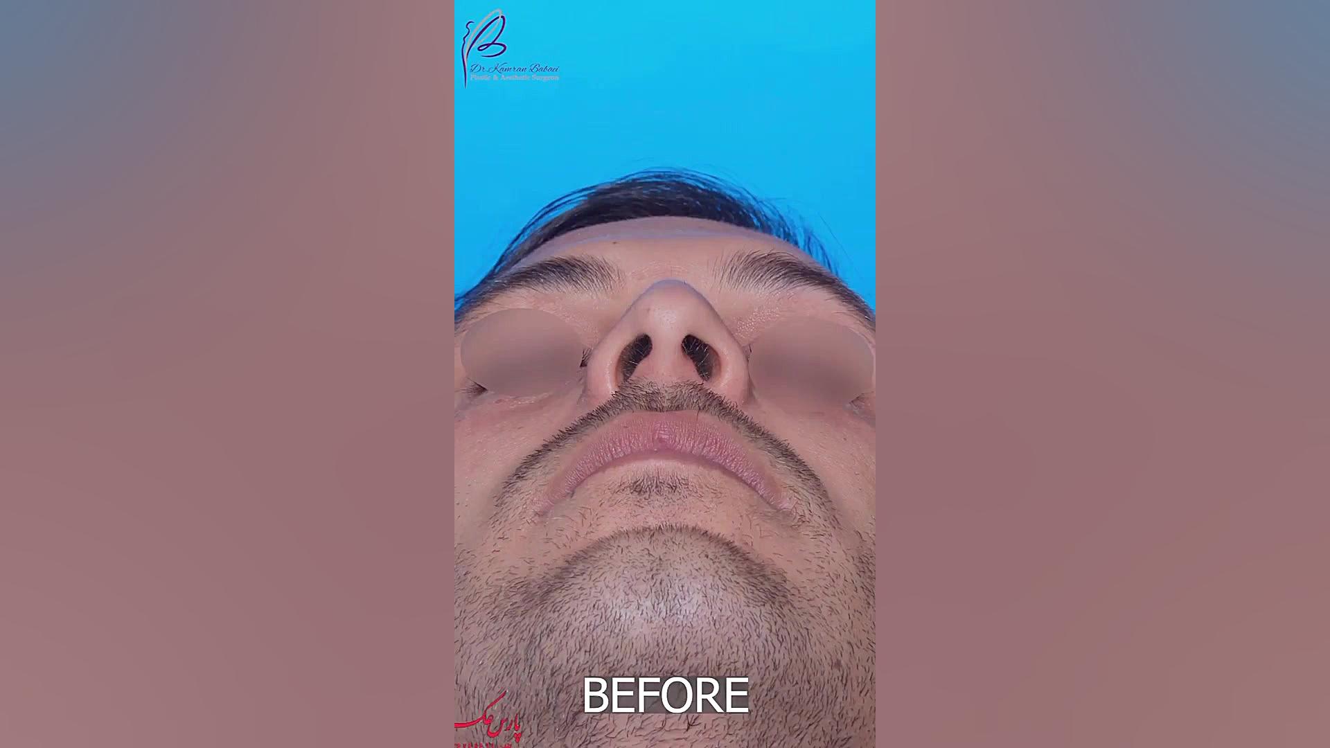 نمونه جراحی زيبايى بينى توسط دكتر كامران بابايى دکتر کامران بابایی