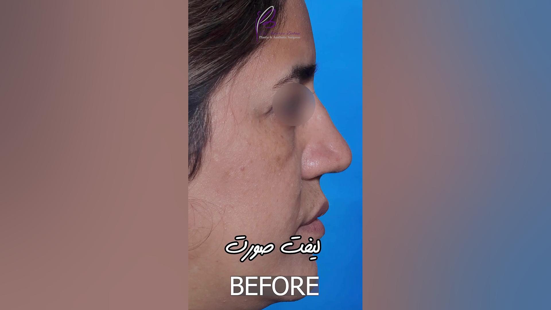دو هفته بعد از عمل لیفت صورت دکتر کامران بابایی