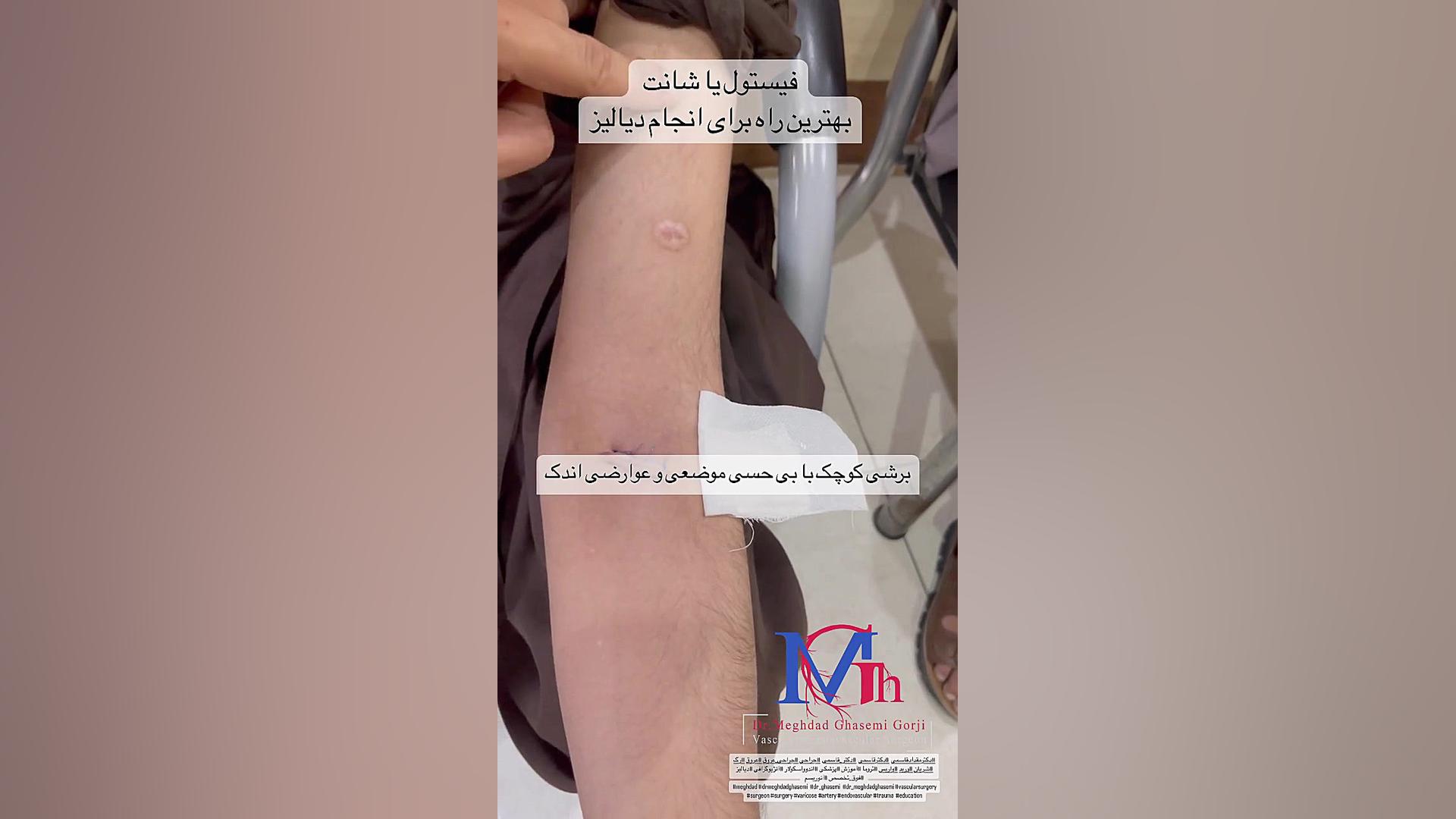 بهترین روش انجام دیالیز میکرونیدلینگ