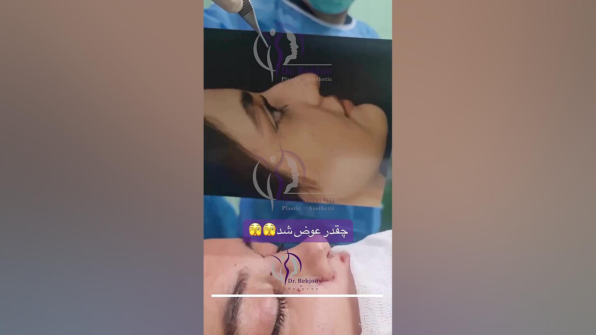 جراحی بینی نیمه فانتزی دکتر شاهین بهجو - فوق تخصص جراحی پلاستیک