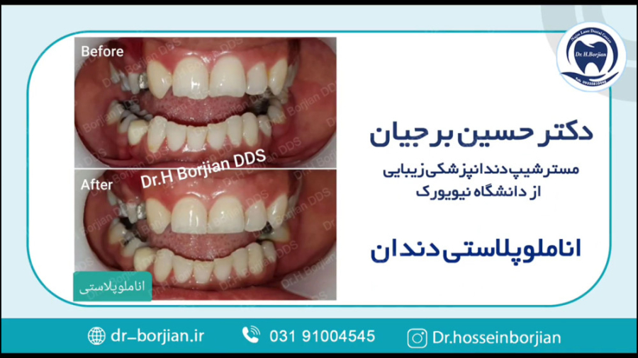 اناملوپلاستی دندان | بهترین دندانپزشک زیبایی اصفهان پوشش زخم هیدروکلوییدی
