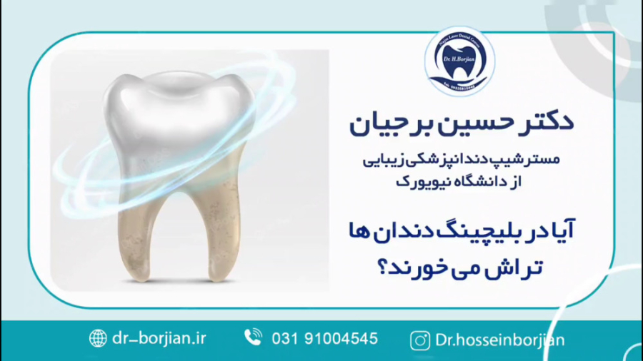 آیا در بلیچینگ دندان ها تراش می خورند؟ | بهترین دندانپزشک زیبایی اصفهان DLCO