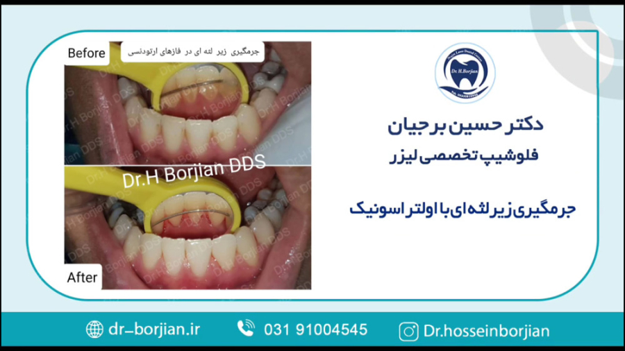 نمونه جرمگیری های زیر لثه ای | بهترین جراح لثه اصفهان بیماری آمیلوئیدوز فامیلیال