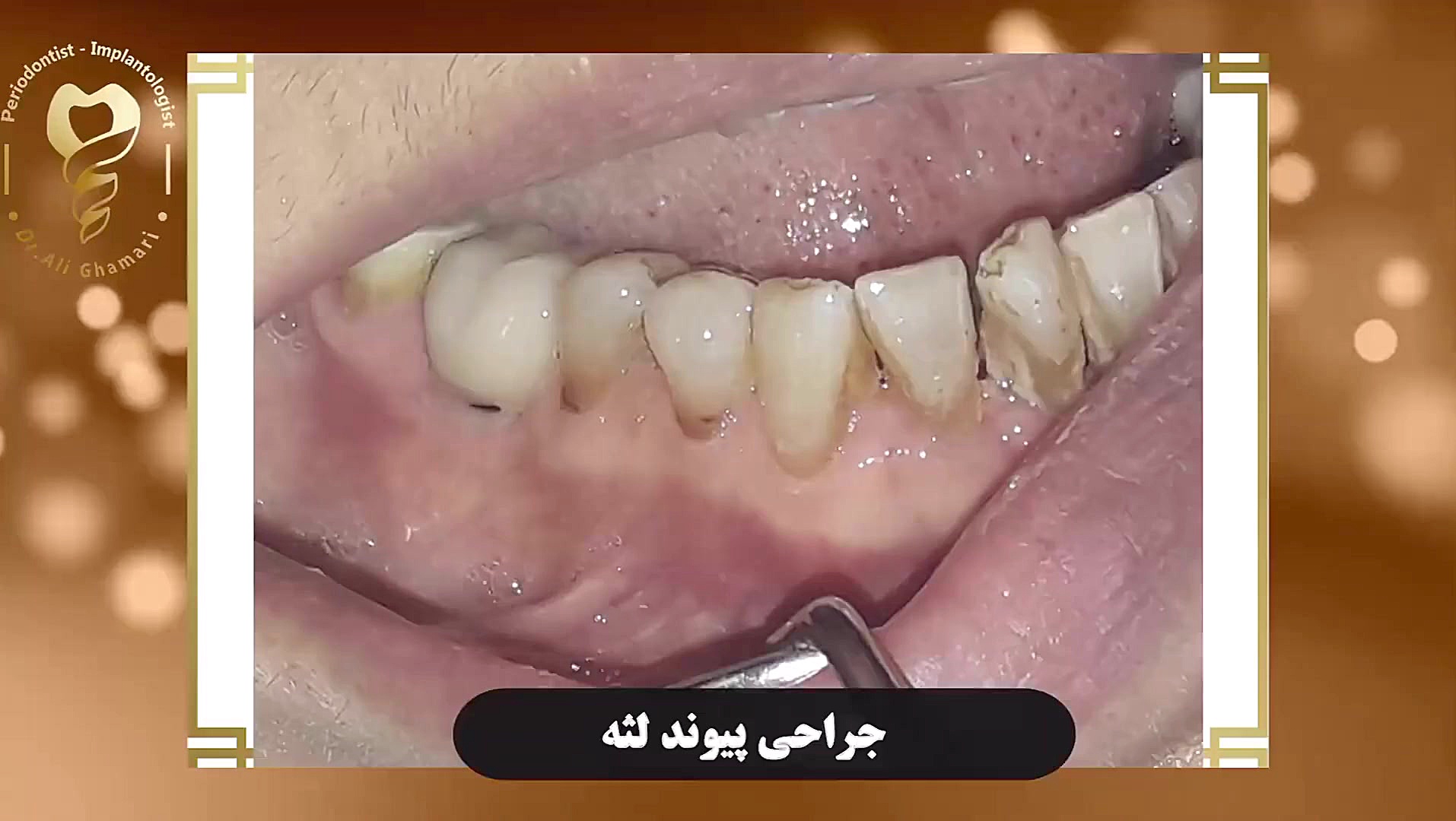 جراحی پیوند لثه دکتر علی قمری - متخصص جراحی لثه و ایمپلنت