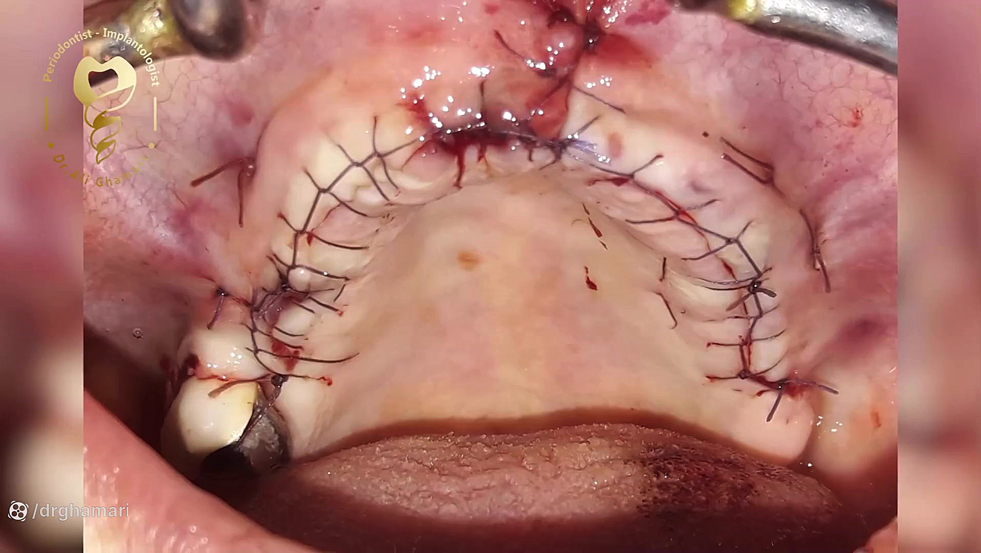 جراحی ایمپلنت به همراه پیوند لثه دکتر علی قمری - متخصص جراحی لثه و ایمپلنت