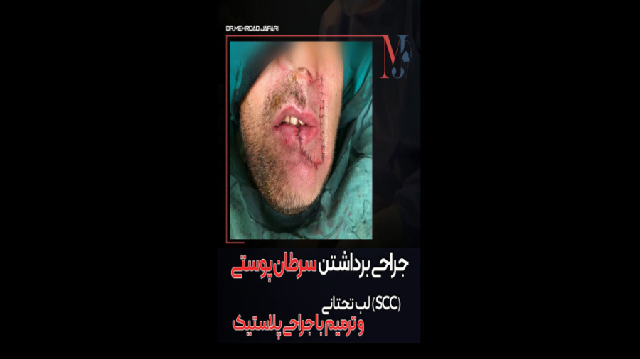 جراحی سرطان لب تحتانی ارتودنسی