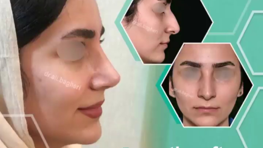 یک ماه بعد از عمل بینی دکتر علی باقری حق
