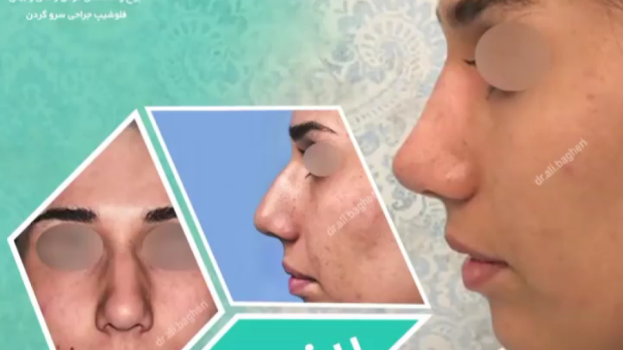 رینوپلاستی با دکتر باقری حق دکتر علی باقری حق
