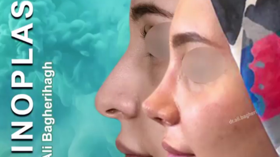جراحی زیبایی بینی در بانوان دکتر علی باقری حق
