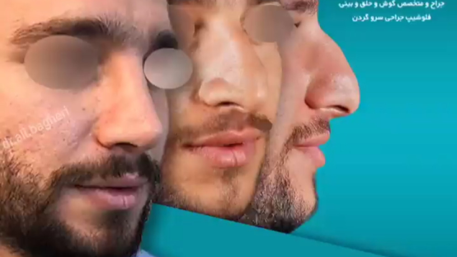 جراحی زیبایی بینی در آقایان دکتر علی باقری حق