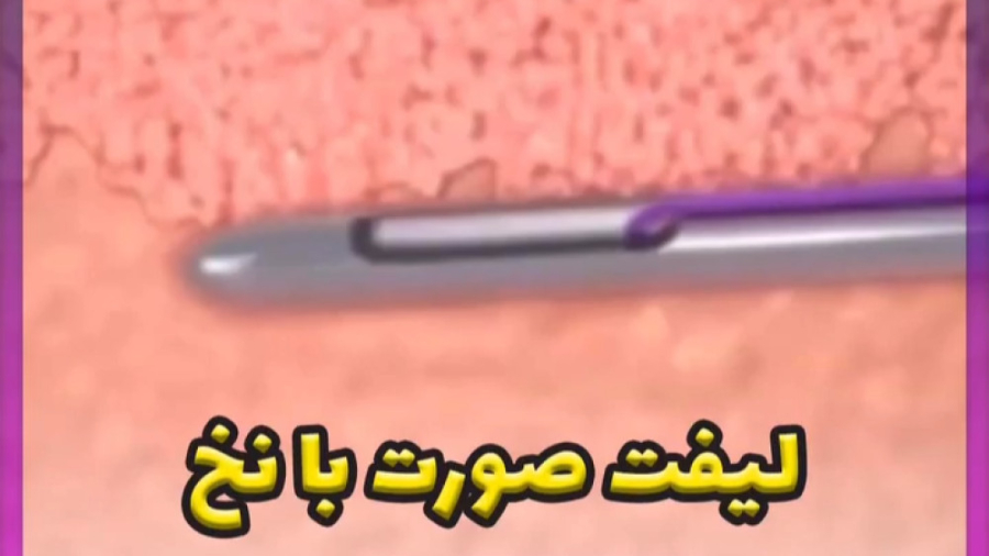 صفر تا صد لیفت صورت با نخ دستگاه آنالیز ایمیجینگ سلول زنده