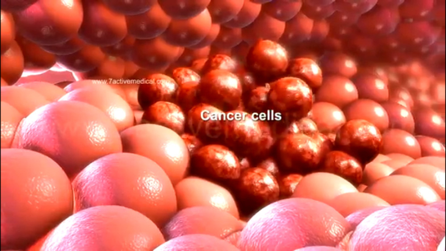 سرطان و شیمی درمانی جرمگیری