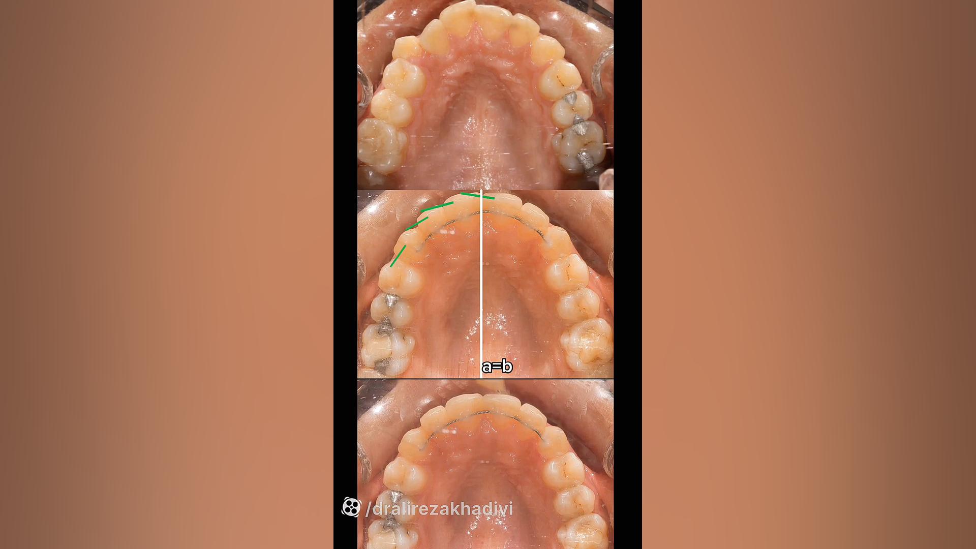 نمونه درمان 11ماه بیمار23 ساله خرس پانداویچ