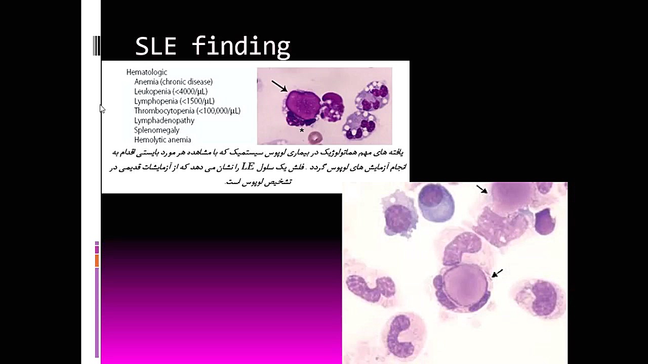 ۱۲- یافته های SLE در لام خون محیطی لیپوساکشن