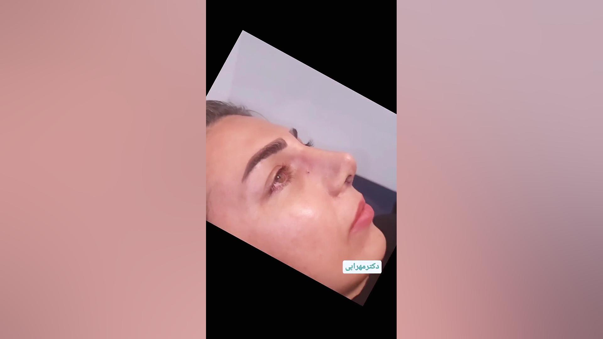عمل بینی استخوانی در شیراز دکتر محمد مهدی مهرابی جراح پلاستیک و زیبایی