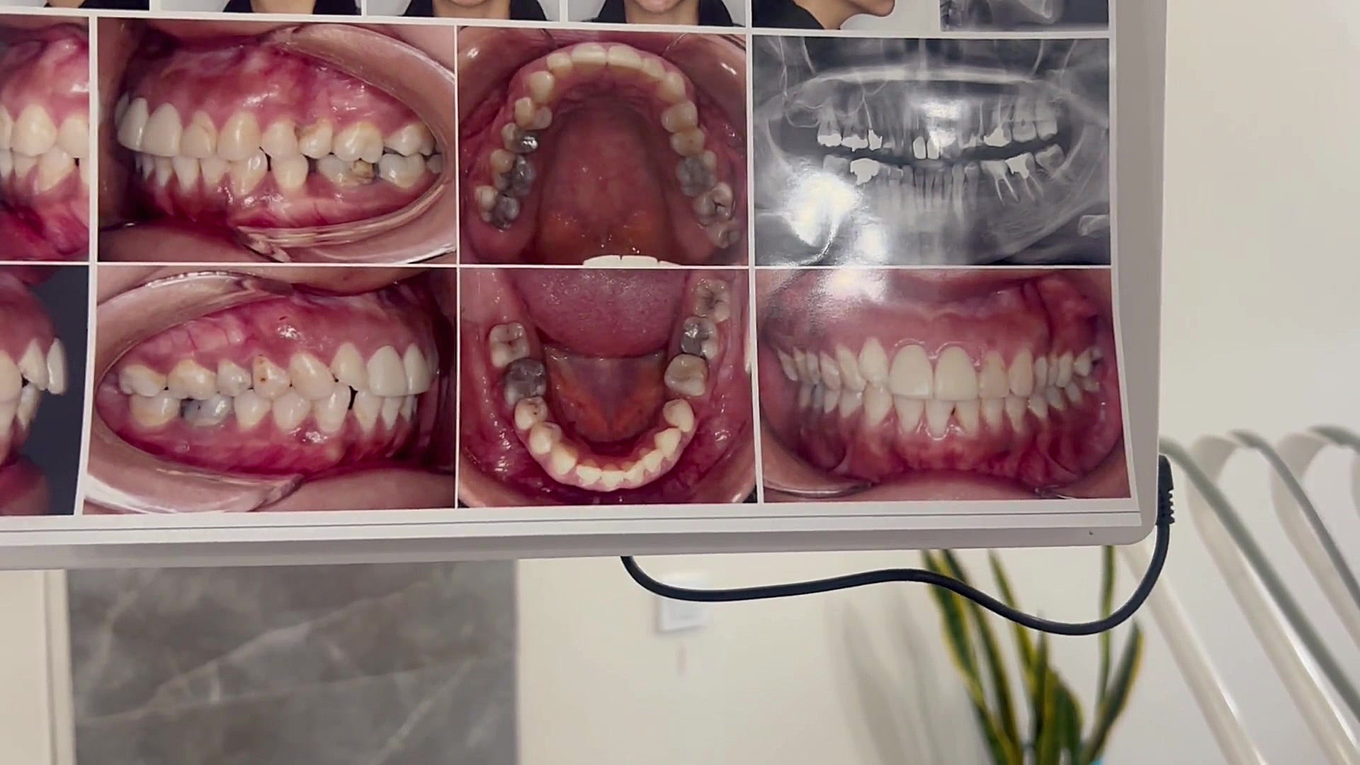 جلسه اول ارتودنسی دکتر مهدی فهیمی دكتر مهدي فهيمي هنزائي