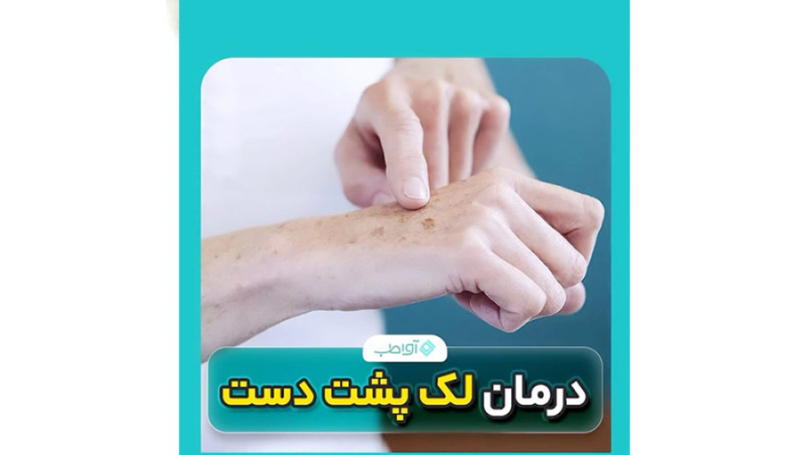 درمان لک پشت دست با کرم ضد لک ژل رویال عصب‌کشی