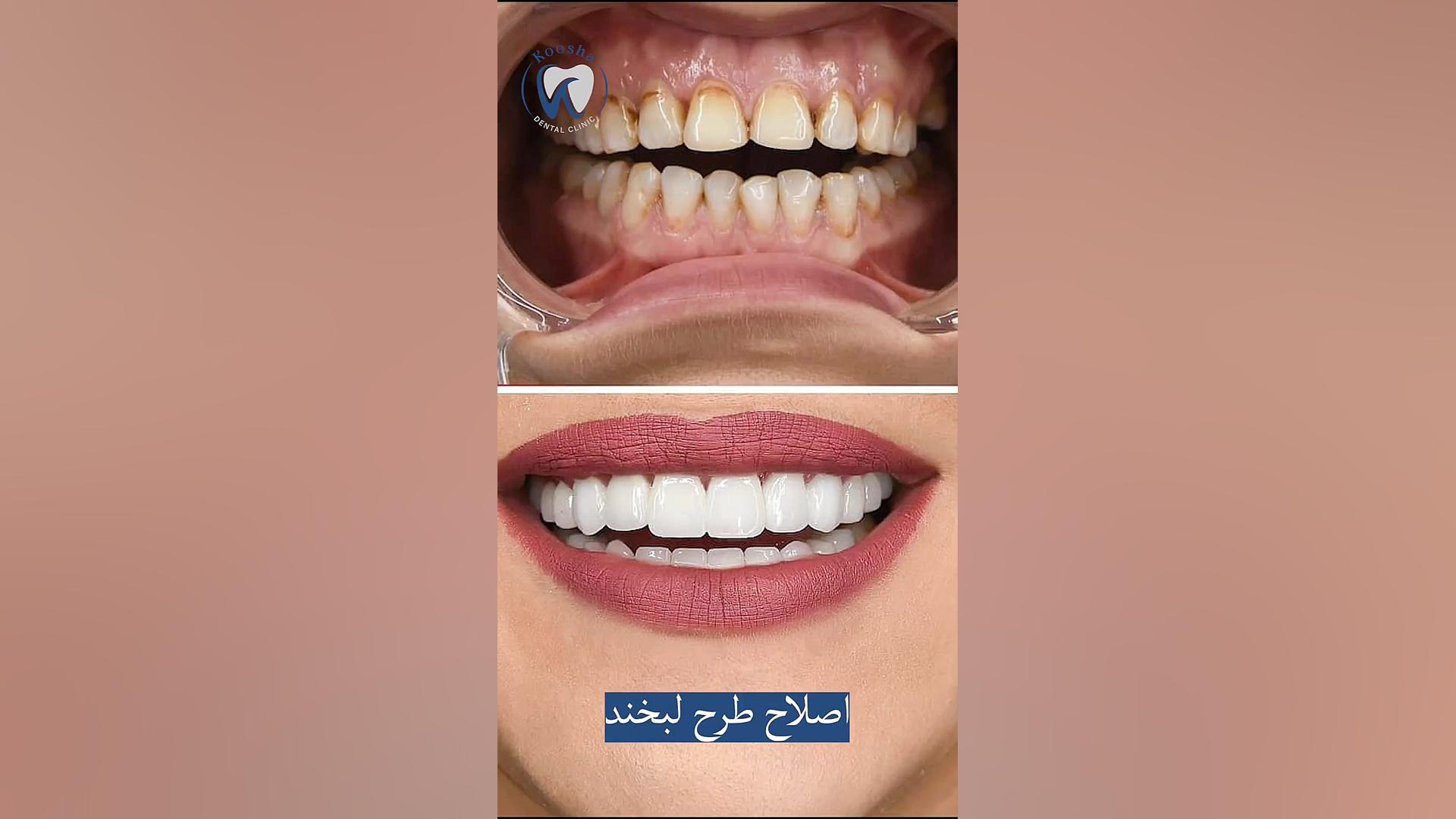فیلم فوق العاده جذاب اصلاح طرح لبخند NET-Seq