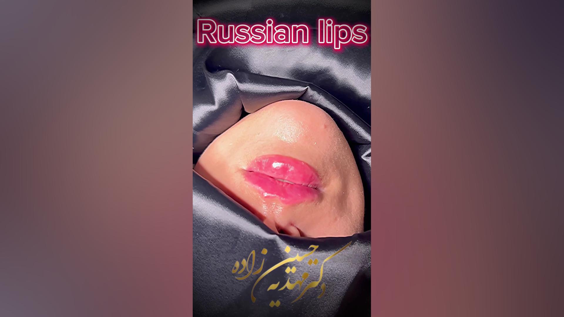 تزریق لب روسی در رشت کلینیک زیبایی رشت دکتر مهدیه حسین زاده