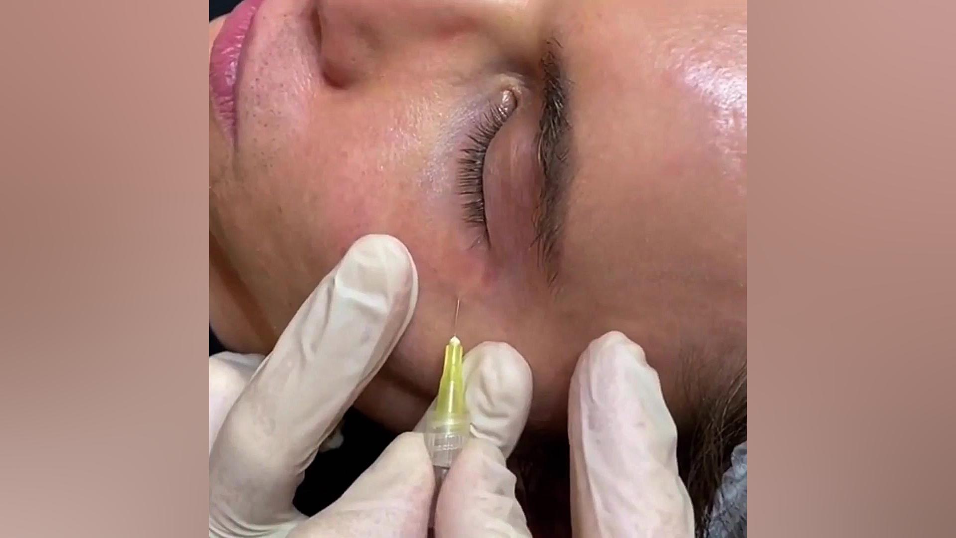 فیلم کربوکسی تراپی صورت (در ناحیه دور چشم) | پوست‌یار انسریدا