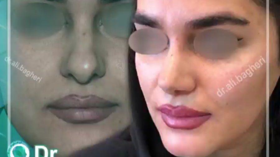 جراحی زیبایی بینی دکتر علی باقری حق
