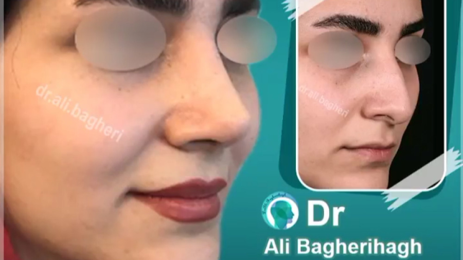 رینوپلاستی در تهران دکتر علی باقری حق